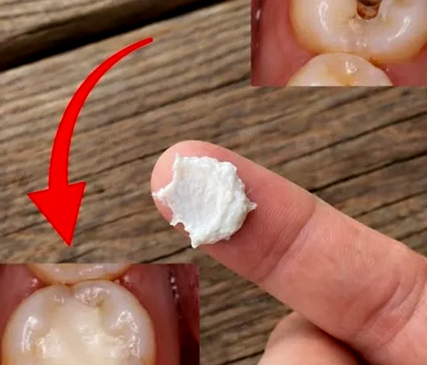 5 Simple Natural Home Remedies to Help Prevent Cavities and Support Healthy Teeth